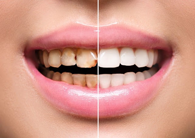 Odontoiatria estetica faccette estetiche dentali smile center dentista verona