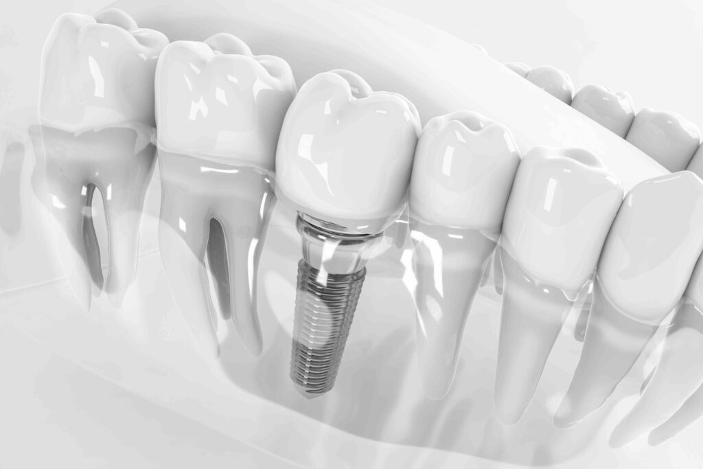 Come orientarsi tra i materiali più usati per gli impianti dentali nello Studio Dentistico Smile Center a Verona 1 materiali più usati per gli impianti